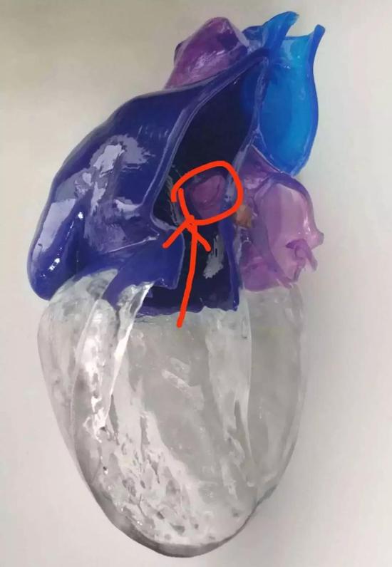 模型演示患者的心脏中间出现一个孔（摄影：邱海龙）